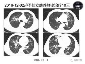 大爷节前大扫除后感染肺曲霉病